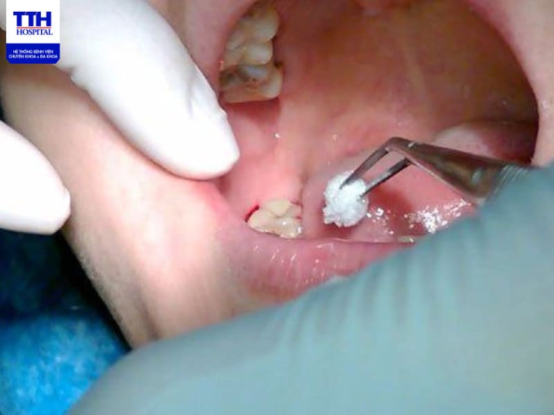 Cách giảm đau khi mọc răng khôn