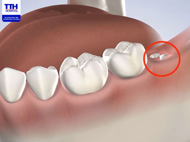 Mọc răng khôn có nguy hiểm không
