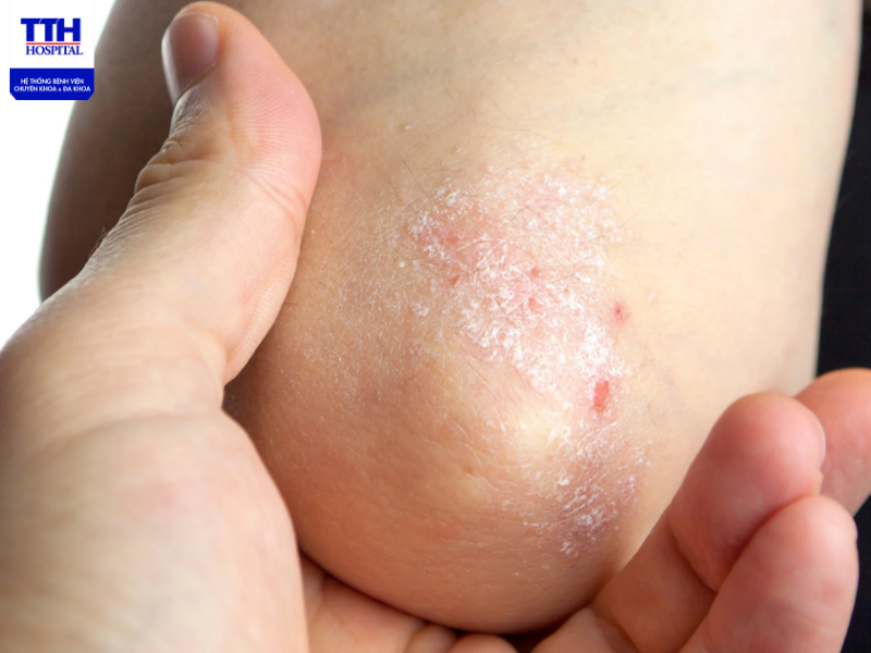 Bệnh vảy nến là căn bệnh gây ảnh hưởng đến cuộc sống cũng như mất thẩm mỹ