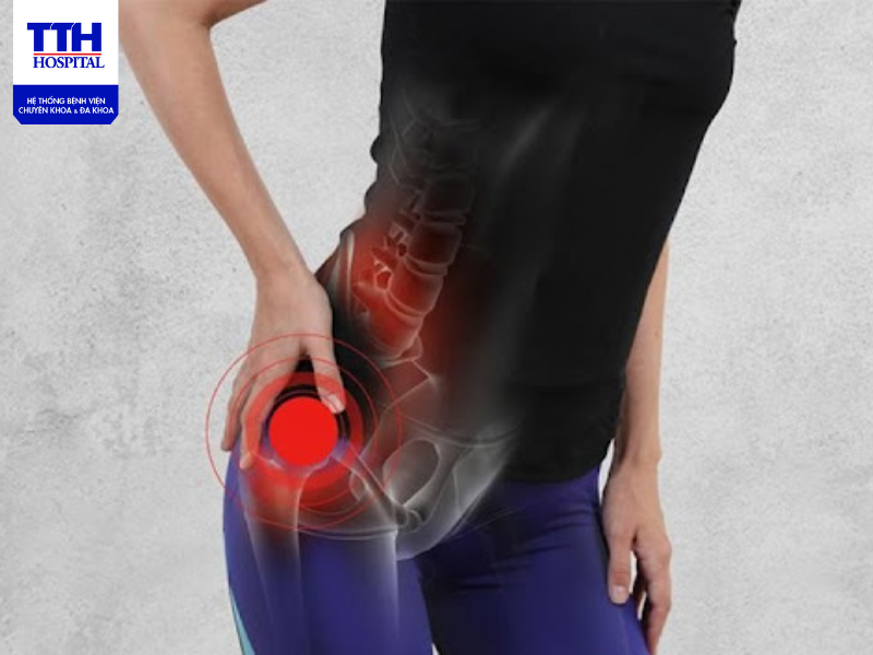 Không phải lúc nào cũng có thể ngăn ngừa đau thần kinh tọa và tình trạng này có thể tái phát