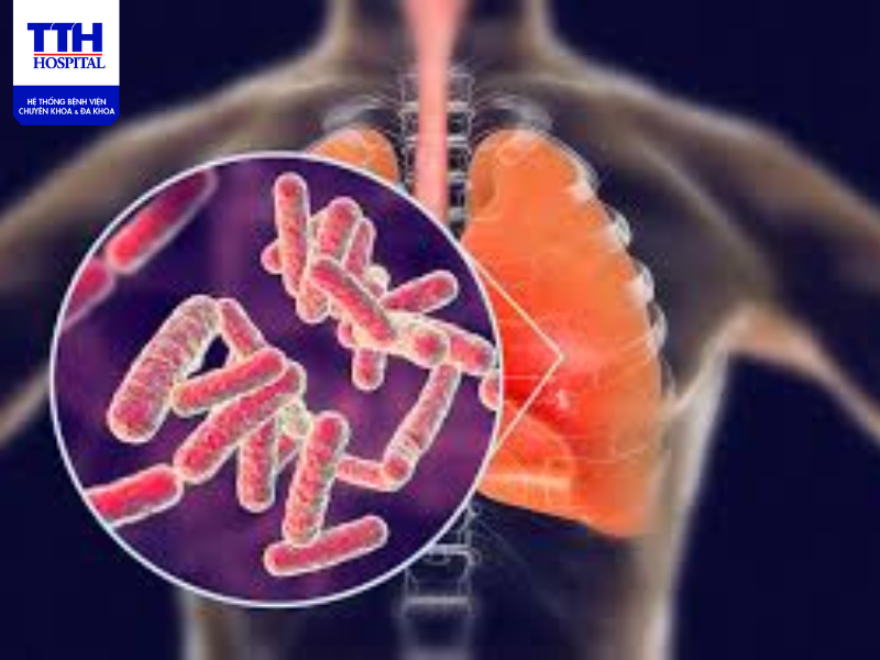 Triệu chứng lao phổi giai đoạn đầu có thể khó nhận biết khiến người bệnh không phát hiện