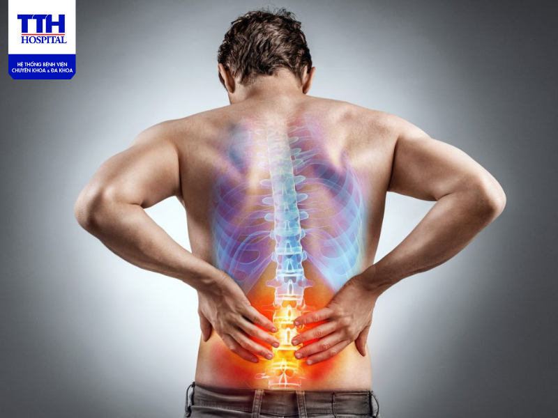 Dấu hiệu đặc biệt nhất của đau thần kinh tọa là cơn đau tỏa ra từ lưng dưới vào lưng hoặc bên cạnh hoặc chân