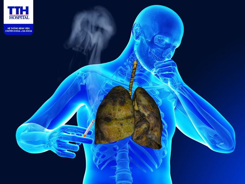 Bệnh lao phổi (tiếng Anh là Pulmonary Tuberculosis) là bệnh truyền nhiễm qua đường hô hấp