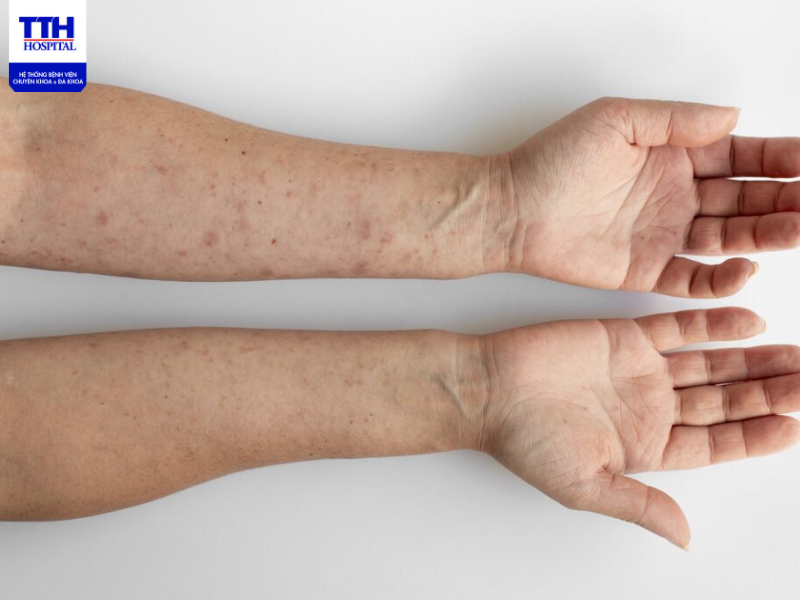 Nấm da là căn bệnh có khả năng lây lan và tái phát khá cao