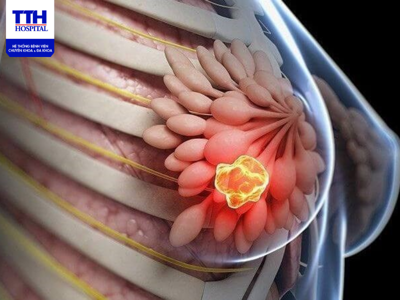 Xạ trị là phương pháp sử dụng các chùm tia năng lượng cao như tia X và proton để diệt các tế bào ung thư