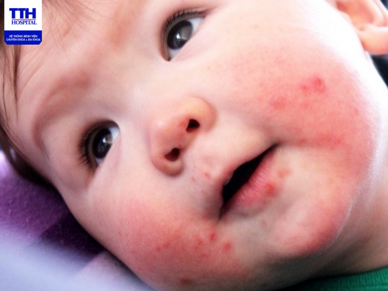 Để chẩn đoán và điều trị bệnh Kawasaki bố mẹ nên đưa con đến cơ sở khám bệnh uy tín sớm nhất