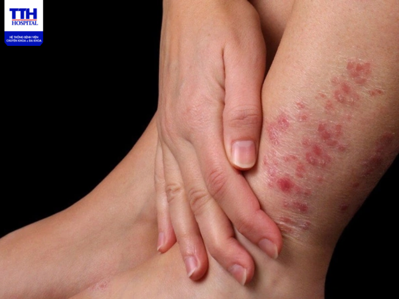 Cần có phương pháp điều trị và phòng ngừa hiệu quả về các bệnh ngoài da