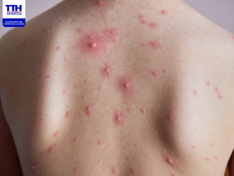 Thủy đậu là bệnh truyền nhiễm gây ra do virus Varicella Zoster (VZV)