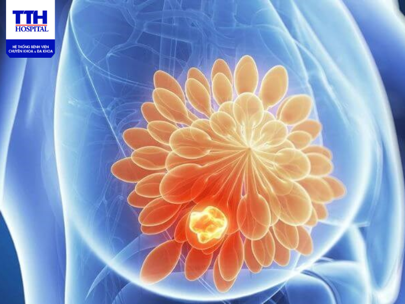 Khám sàng lọc ung thư vú, và kiểm tra sức khỏe định kỳ