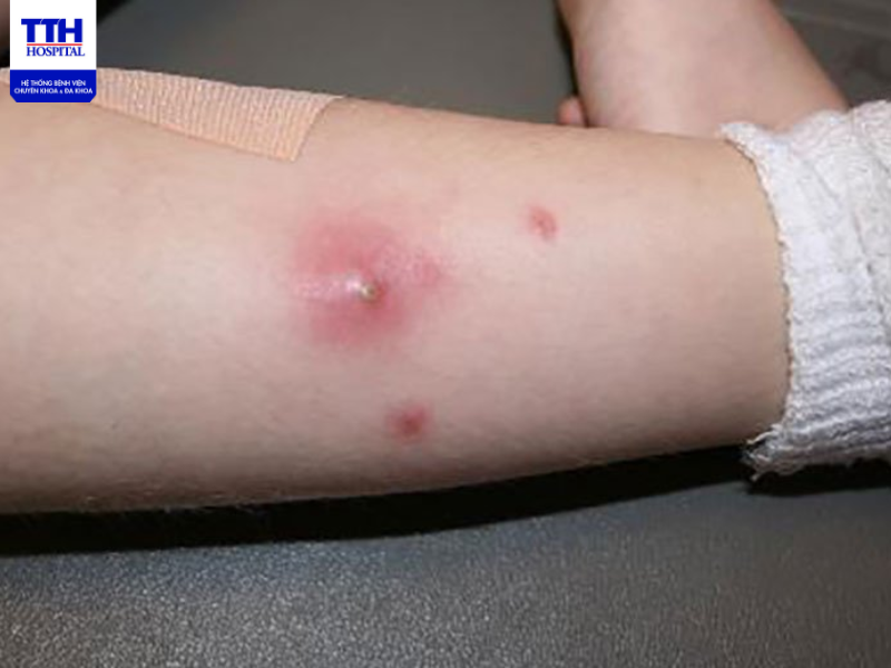 Bệnh viêm da mủ là bệnh ngoài da thường xảy ra vào mùa hè