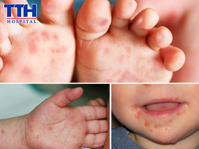 Biến chứng nguy hiểm không nên chủ quan