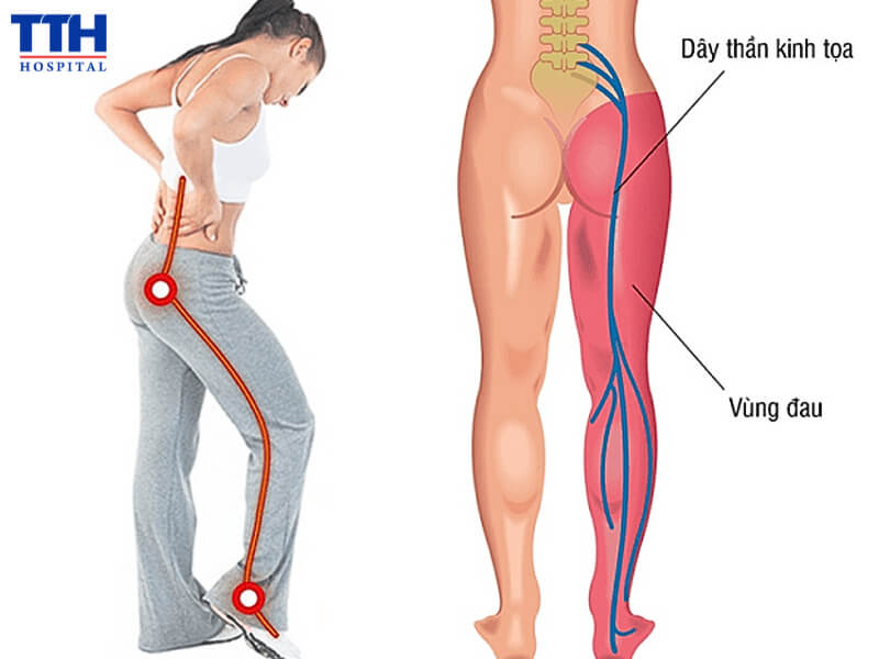 Dây thần kinh tọa nằm ở đâu?