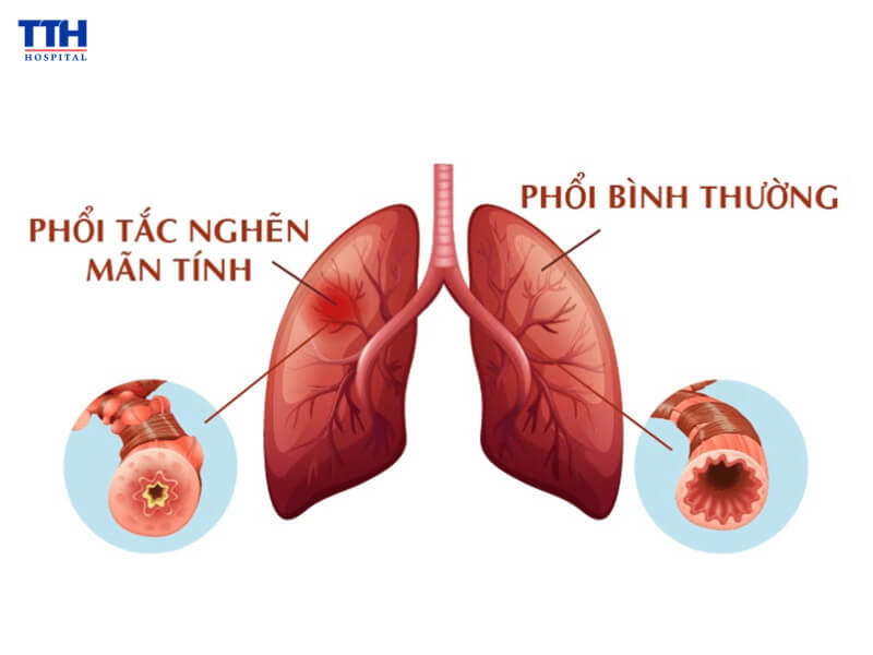 Hình ảnh so sánh phổi bình thường và phổi mắc COPD