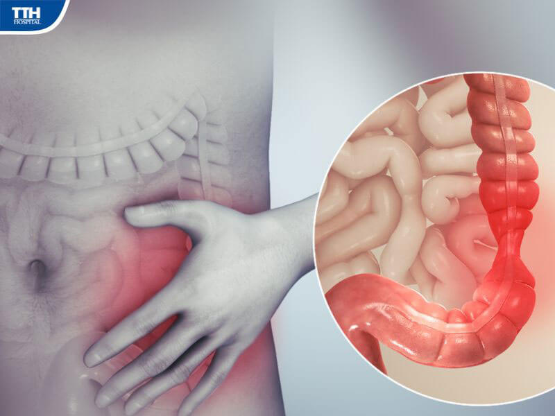 Hội chứng ruột kích thích
