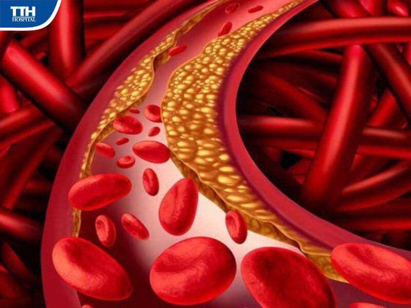 Nguyên nhân gây mỡ máu cao ở người cao tuổi