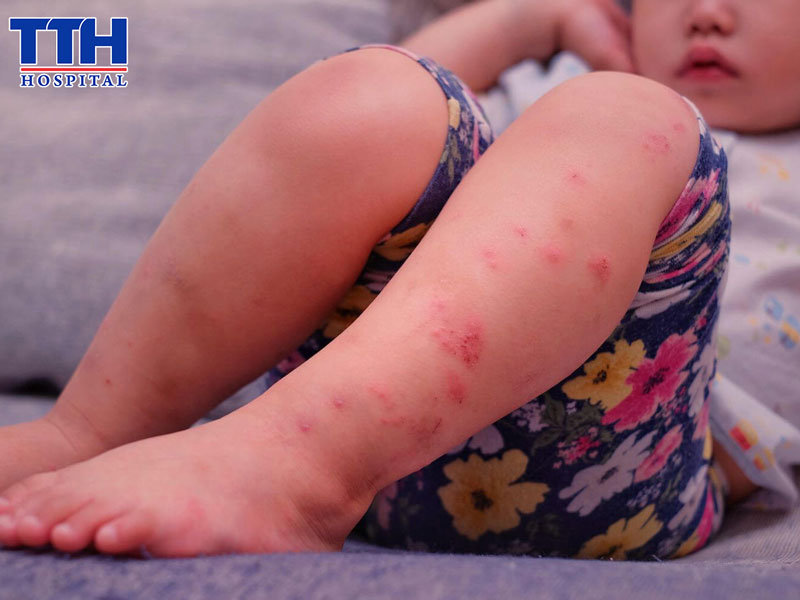 Tay chân miệng là gì? Vì sao dễ lây lan?