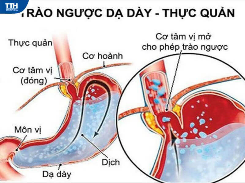 Trào ngược dạ dày, thực quản
