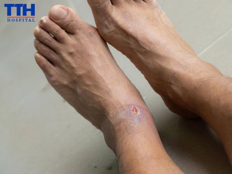 Vì sao đái tháo đường khiến da dễ nhiễm trùng?