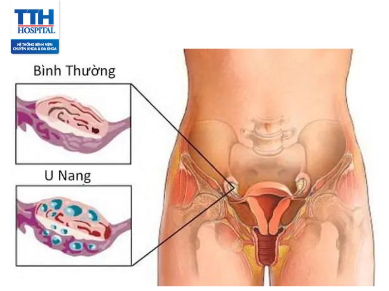 U nang buồng trứng: Nguyên nhân, dấu hiệu nhận biết và cách điều trị 