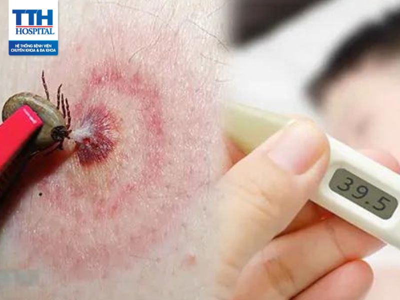 Bệnh Babesia là bệnh gì? Triệu chứng, nguyên nhân và phương pháp điều trị