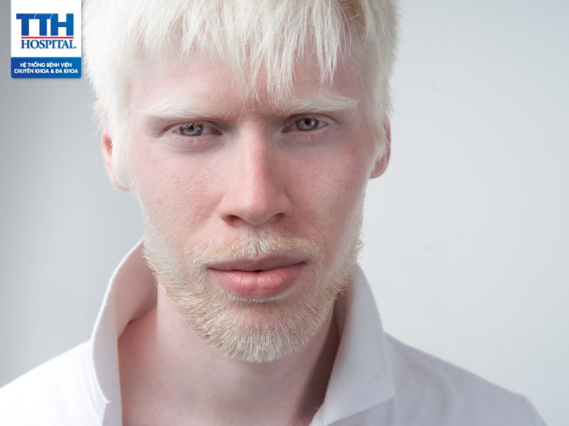 Bệnh bạch tạng (albinism): Dấu hiệu nhận biết người bị bệnh bạch tạng