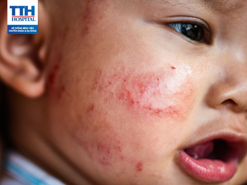 Bệnh chàm da (Eczema): Dấu hiệu, nguyên nhân, biến chứng & điểu trị