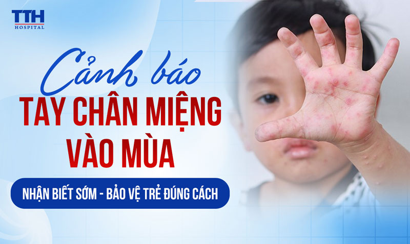 CẢNH BÁO TAY CHÂN MIỆNG VÀO MÙA: NHẬN BIẾT SỚM - BẢO VỆ TRẺ ĐÚNG CÁCH