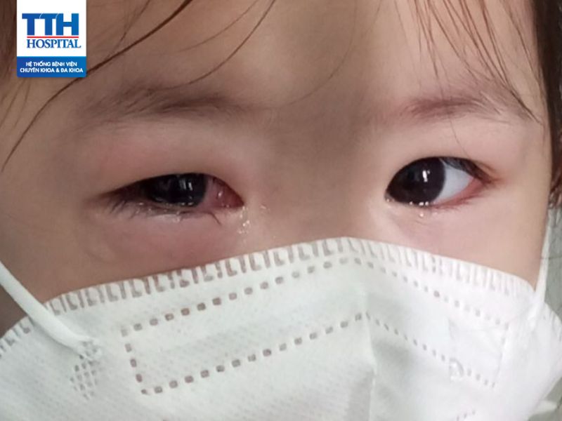 Đau mắt đỏ: Triệu chứng, nguyên nhân và điều trị