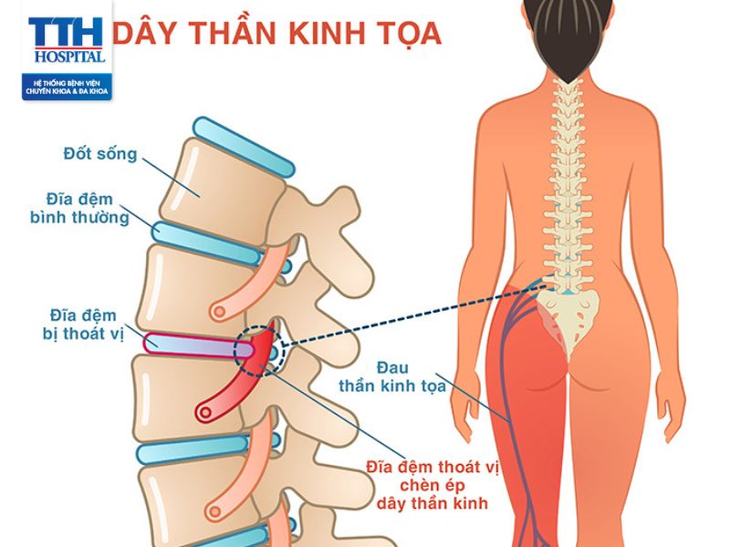 Dây thần kinh tọa là gì? Biến chứng của đau thần kinh tọa