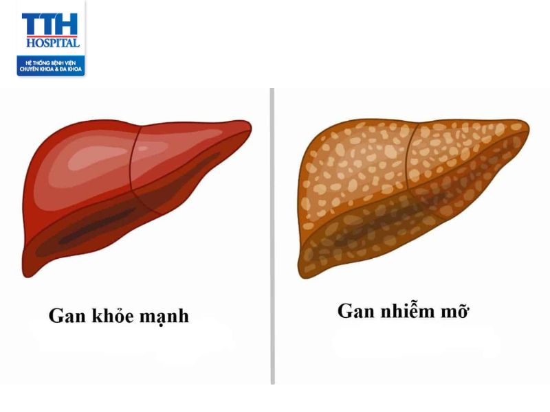 Gan nhiễm mỡ: Nguyên nhân, dấu hiệu và điều trị