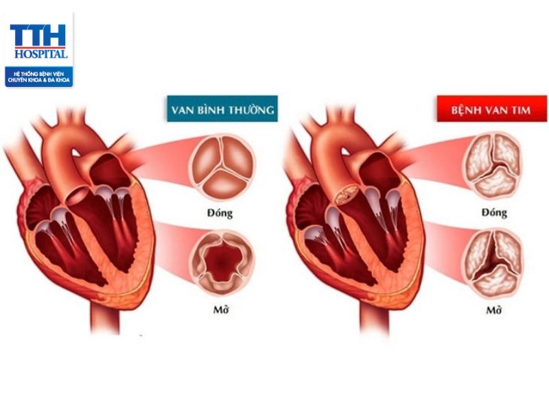 Hở van tim có nguy hiểm không? Dấu hiệu, nguyên nhân, điều trị