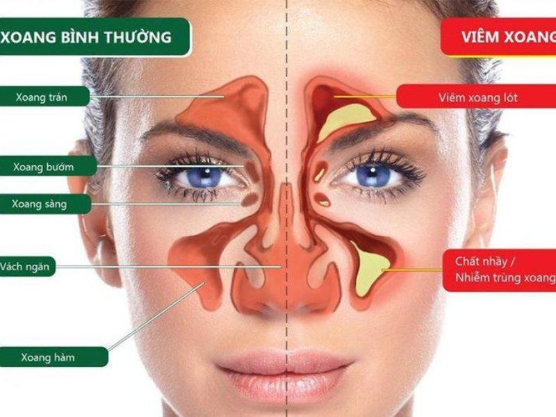 Viêm xoang: Nguyên nhân, triệu chứng và phương pháp điều trị